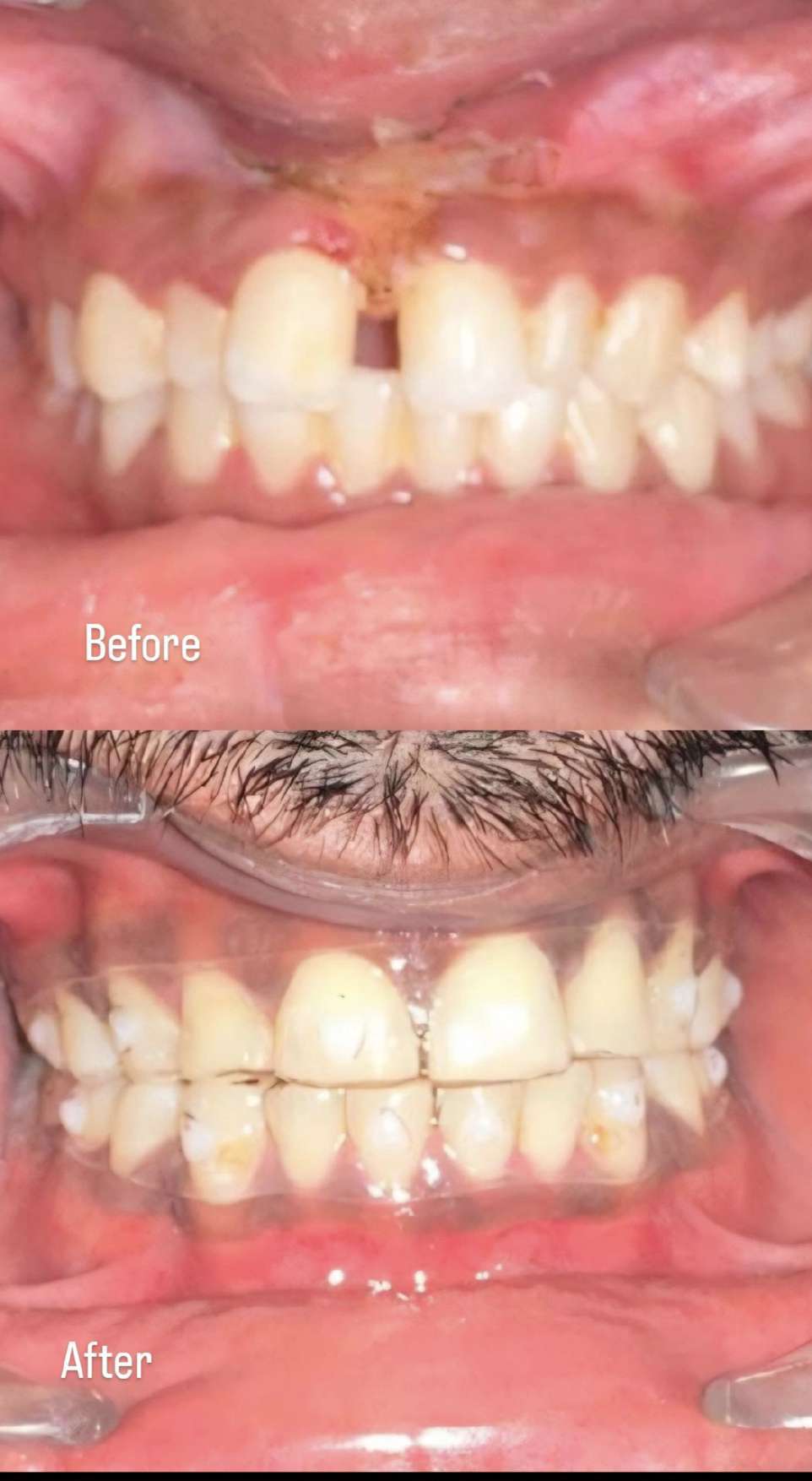 Before and after clear aligner treatment for gap closure