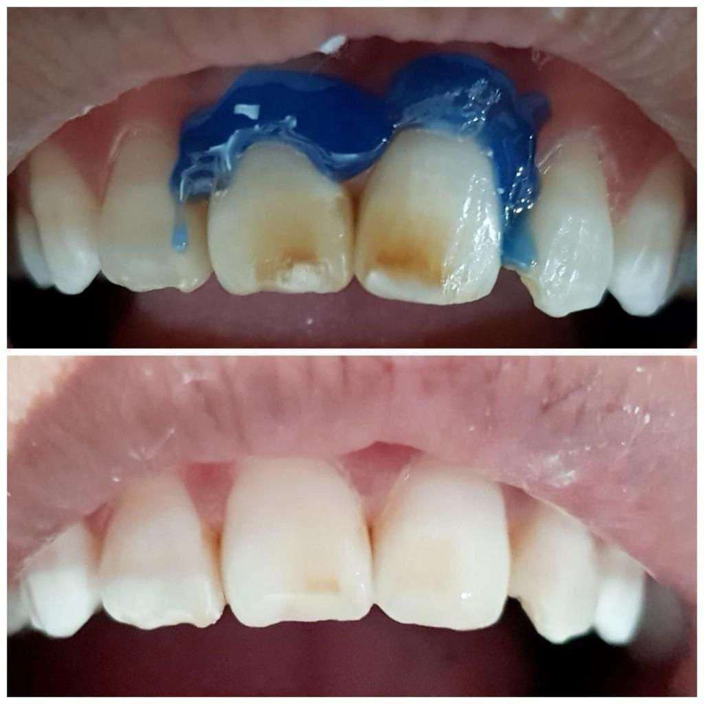 Before and after professional teeth whitening treatment