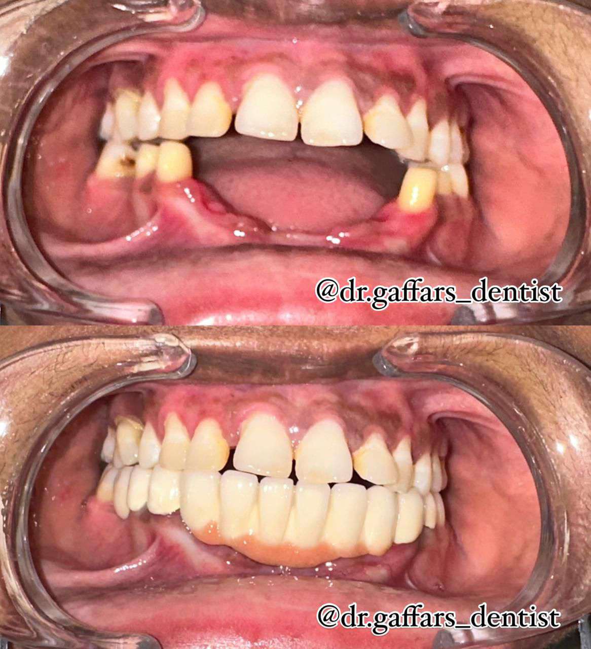 Before and after dental bridge replacing missing lower teeth
